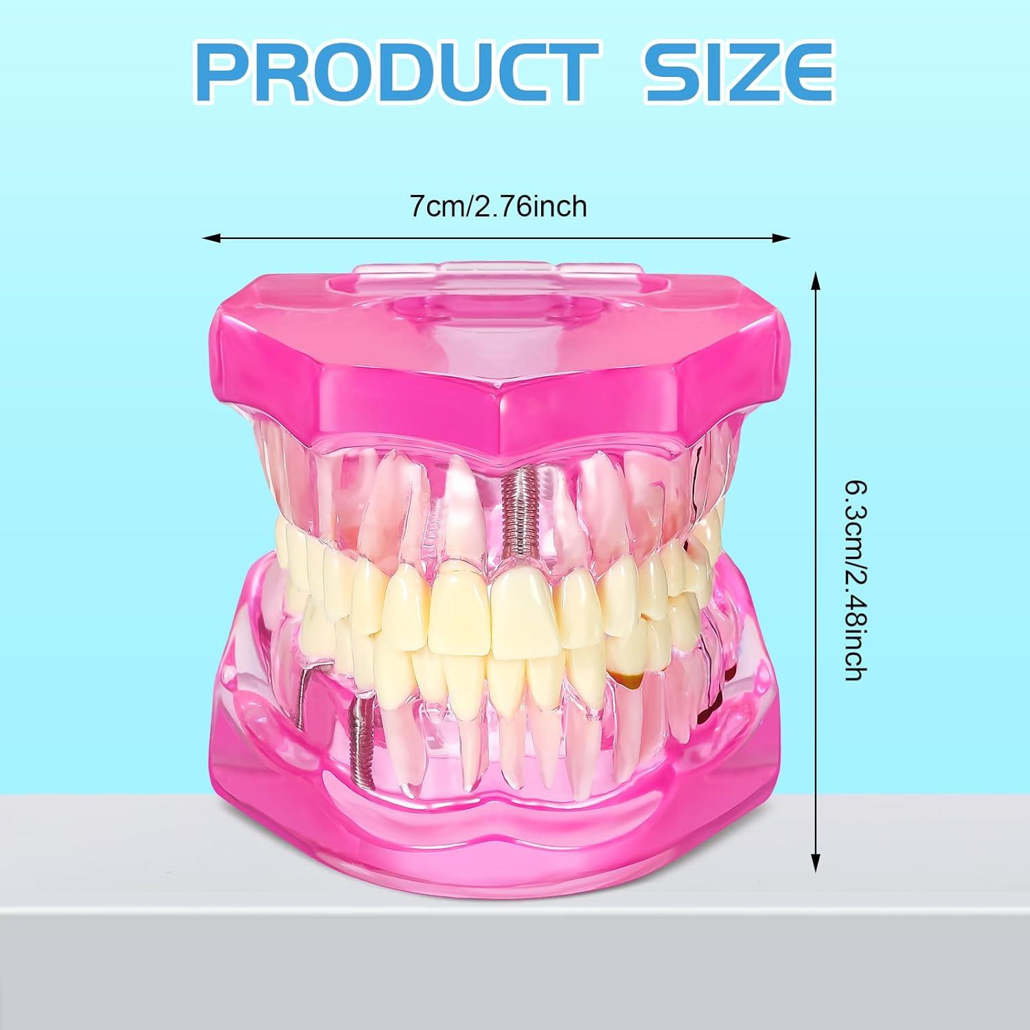 Modelo de Dientes Patológicos Rosa Outus para Educación Dental