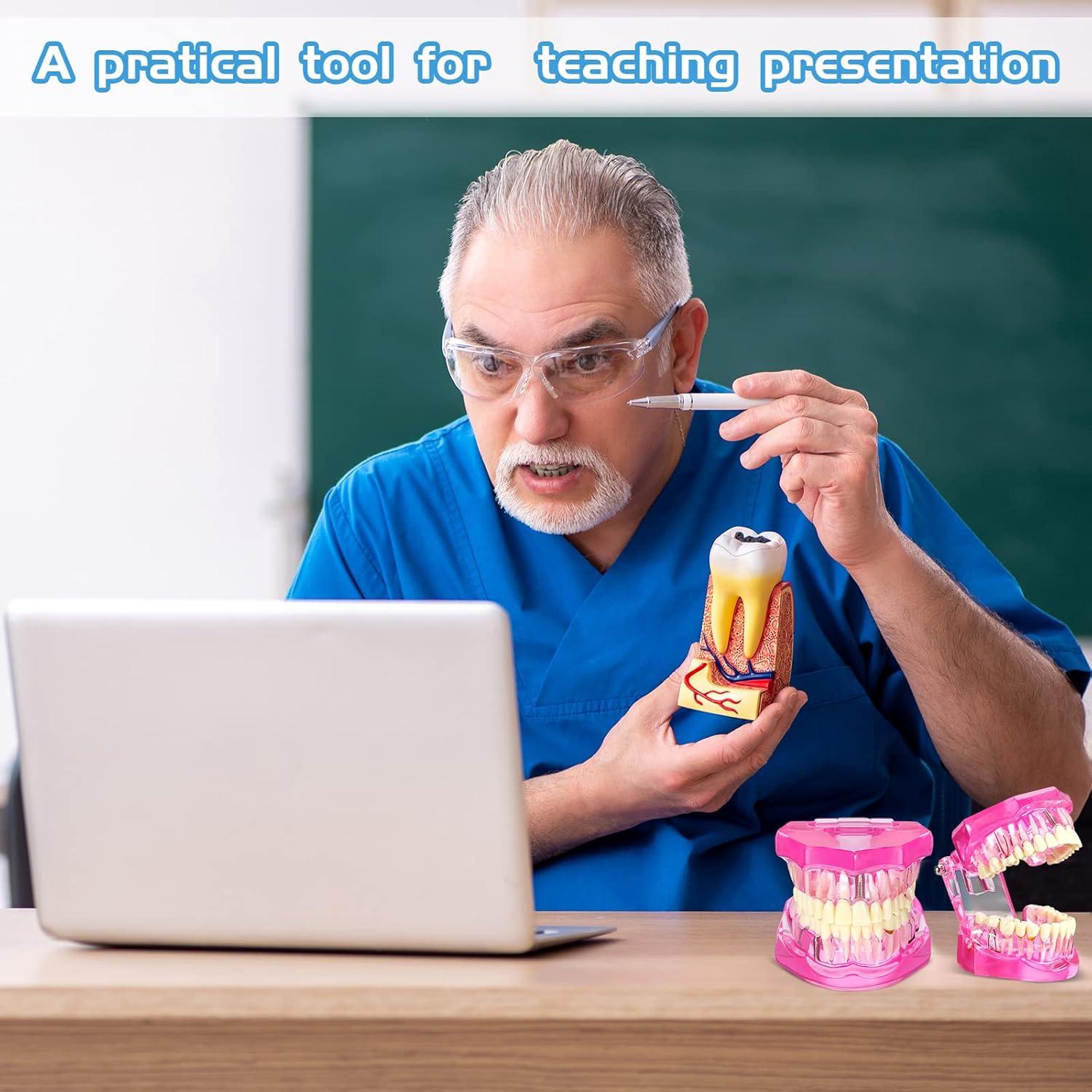 Modelo de Dientes Patológicos Rosa Outus para Educación Dental