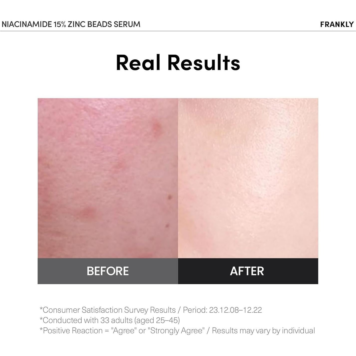 Suero Niacinamida 15% + Zinc Frankly 30 ml - Control Acné y Poros