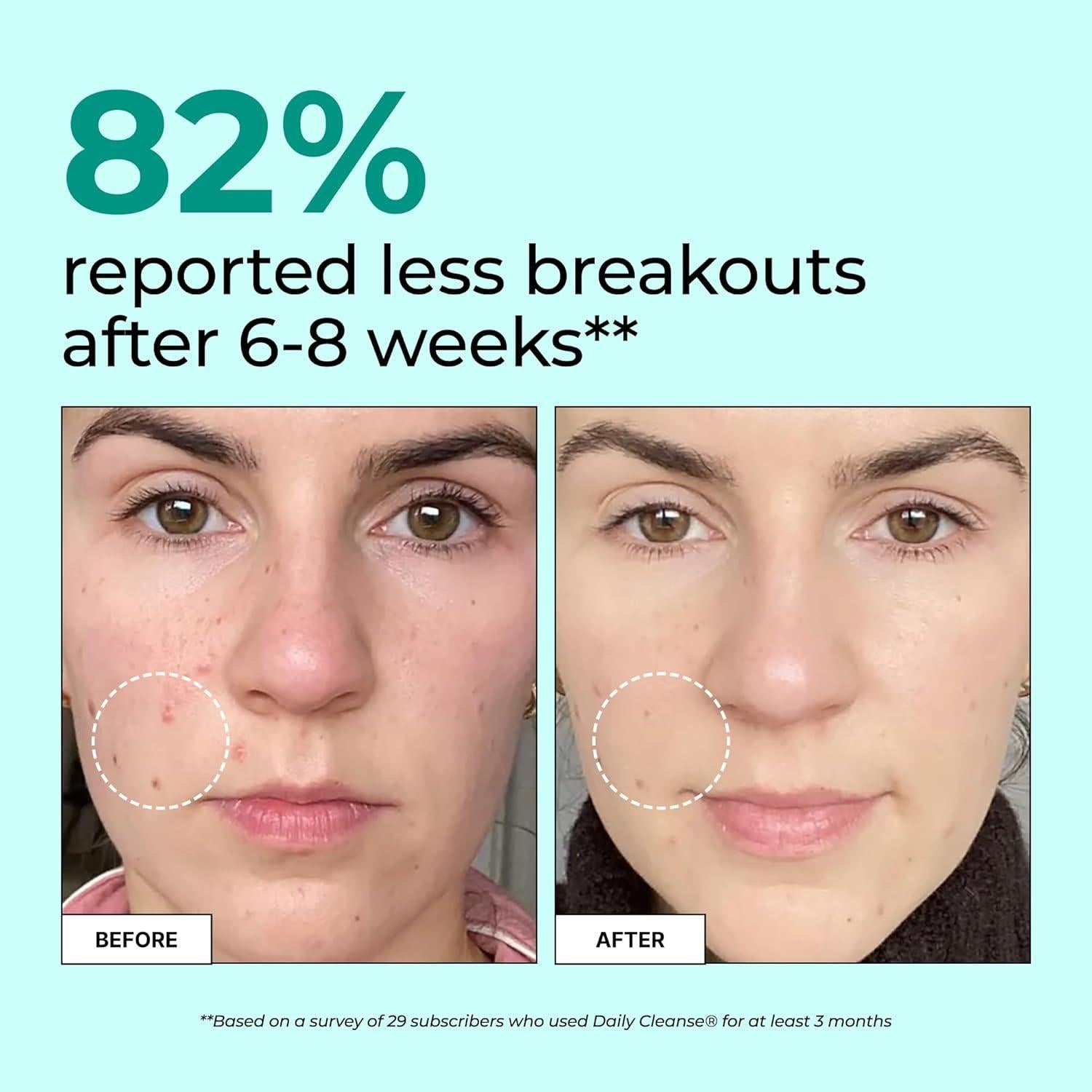 Suplemento HUM de Limpieza Diaria para Acné - 60 Cápsulas