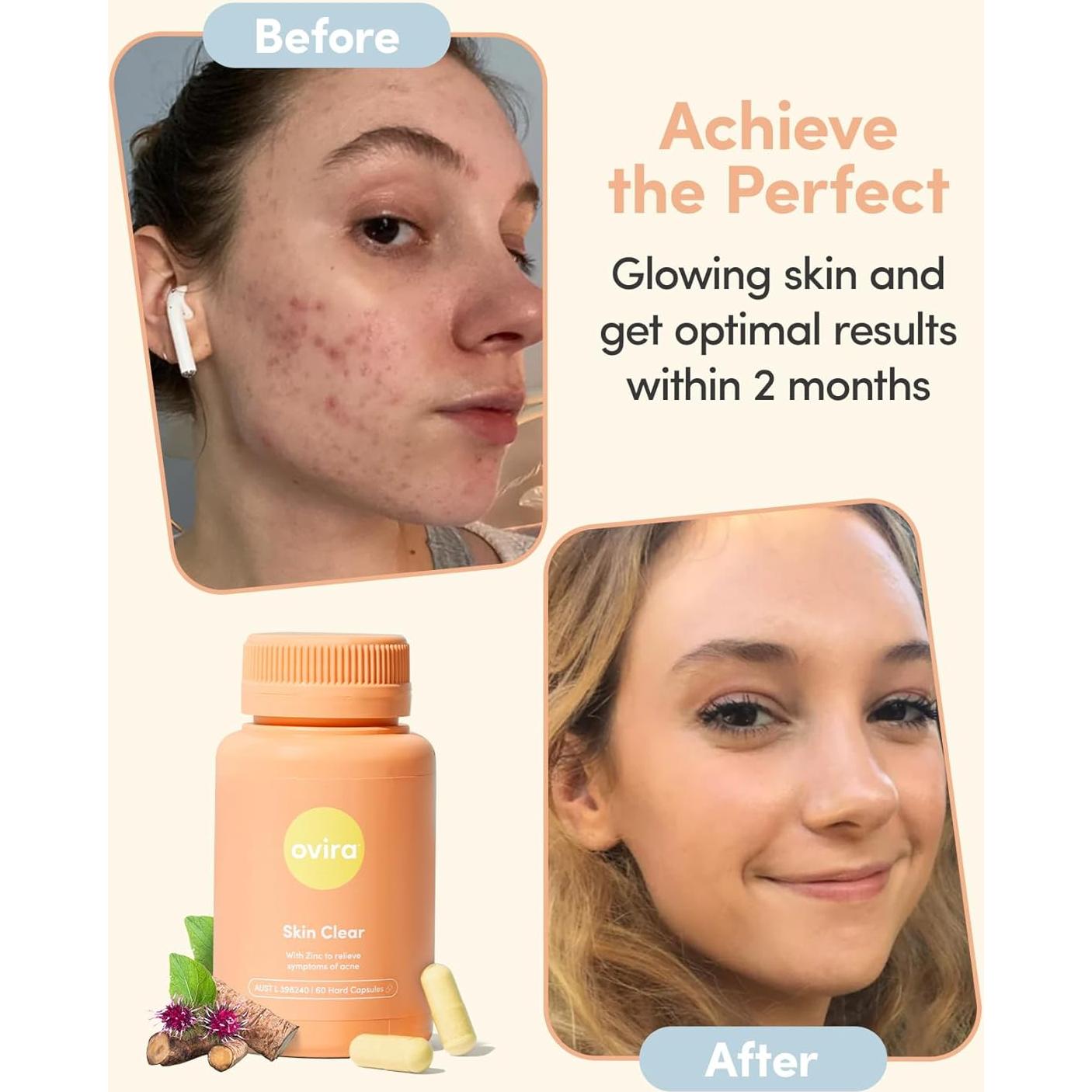 Ovira Piel Clara - 60 Cápsulas para Acné y Rosácea