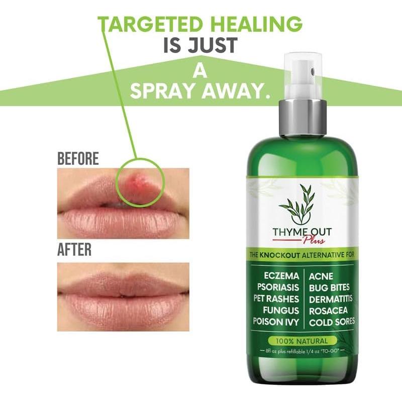 Spray Antipicazón Thyme Out Plus 237ml - Alivio Eczema, Psoriasis