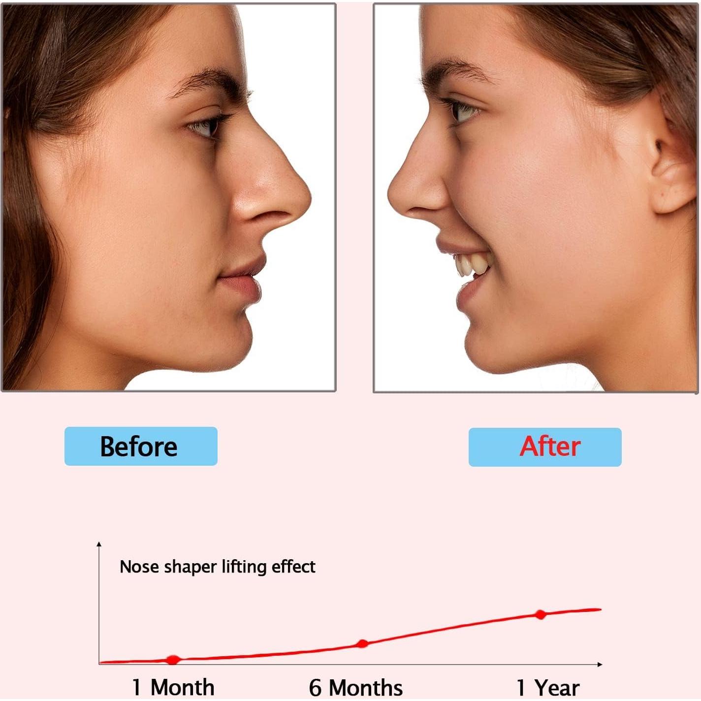 Clip levantador de nariz Syalong - Herramienta de belleza unisex