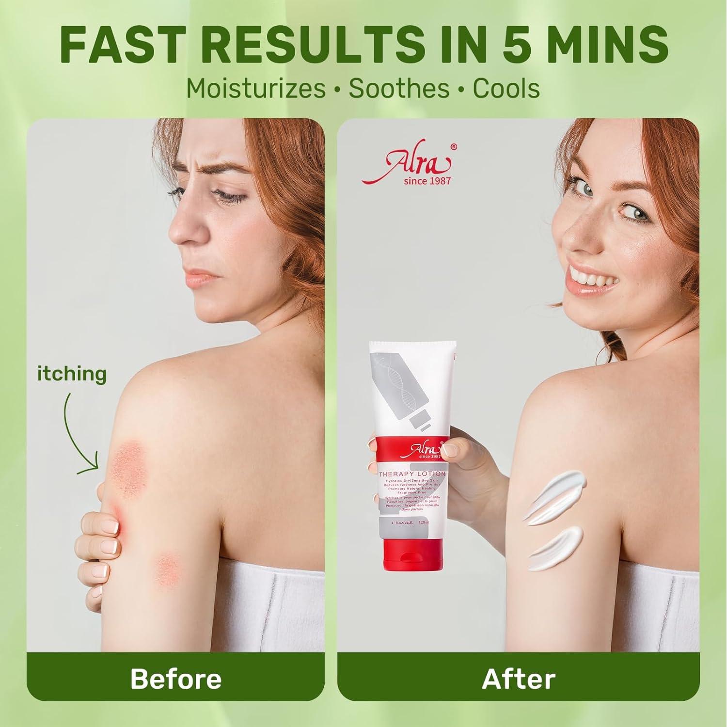 Crema Hidratante Alra con Aloe Vera 113 g - Piel Seca y Picazón