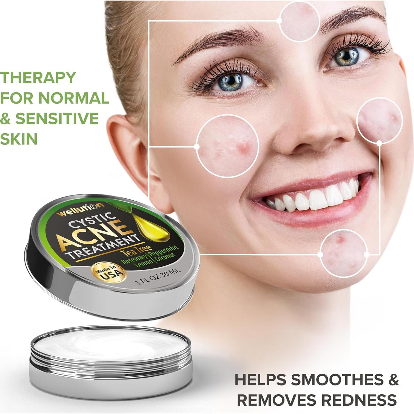 Tratamiento Natural para Manchas de Acné Quístico Wellution 28g