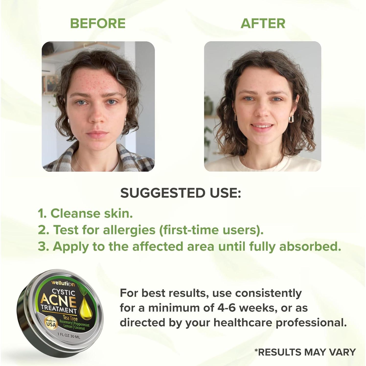 Tratamiento Natural para Manchas de Acné Quístico Wellution 28g