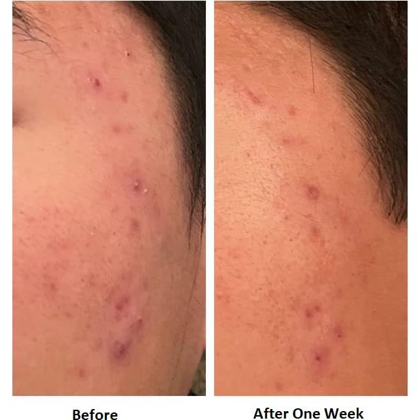 Crema BumpKilla para Acné Facial y Corporal - 248g