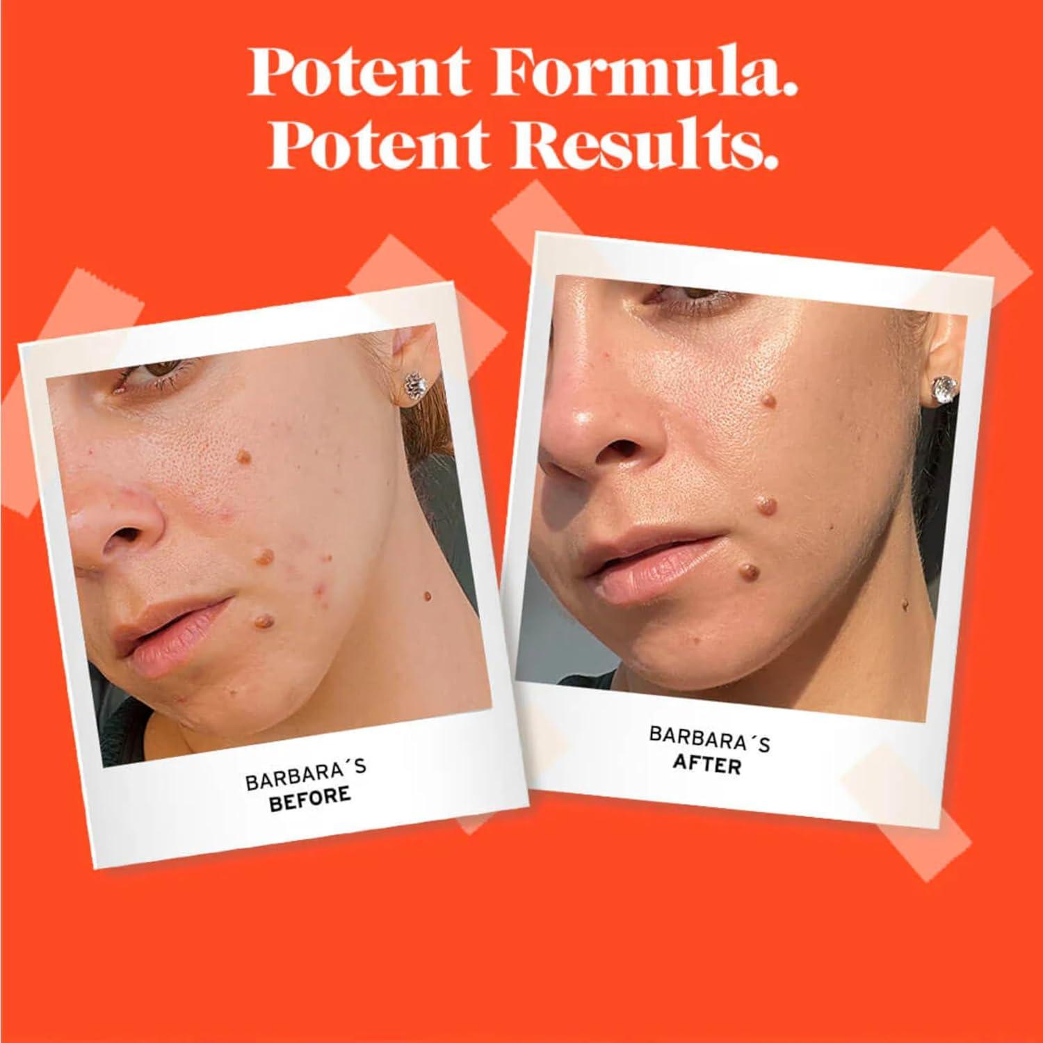 Tratamiento para Manchas de Acné No Bad Stuff 14 g - 2% Ácido Salicílico