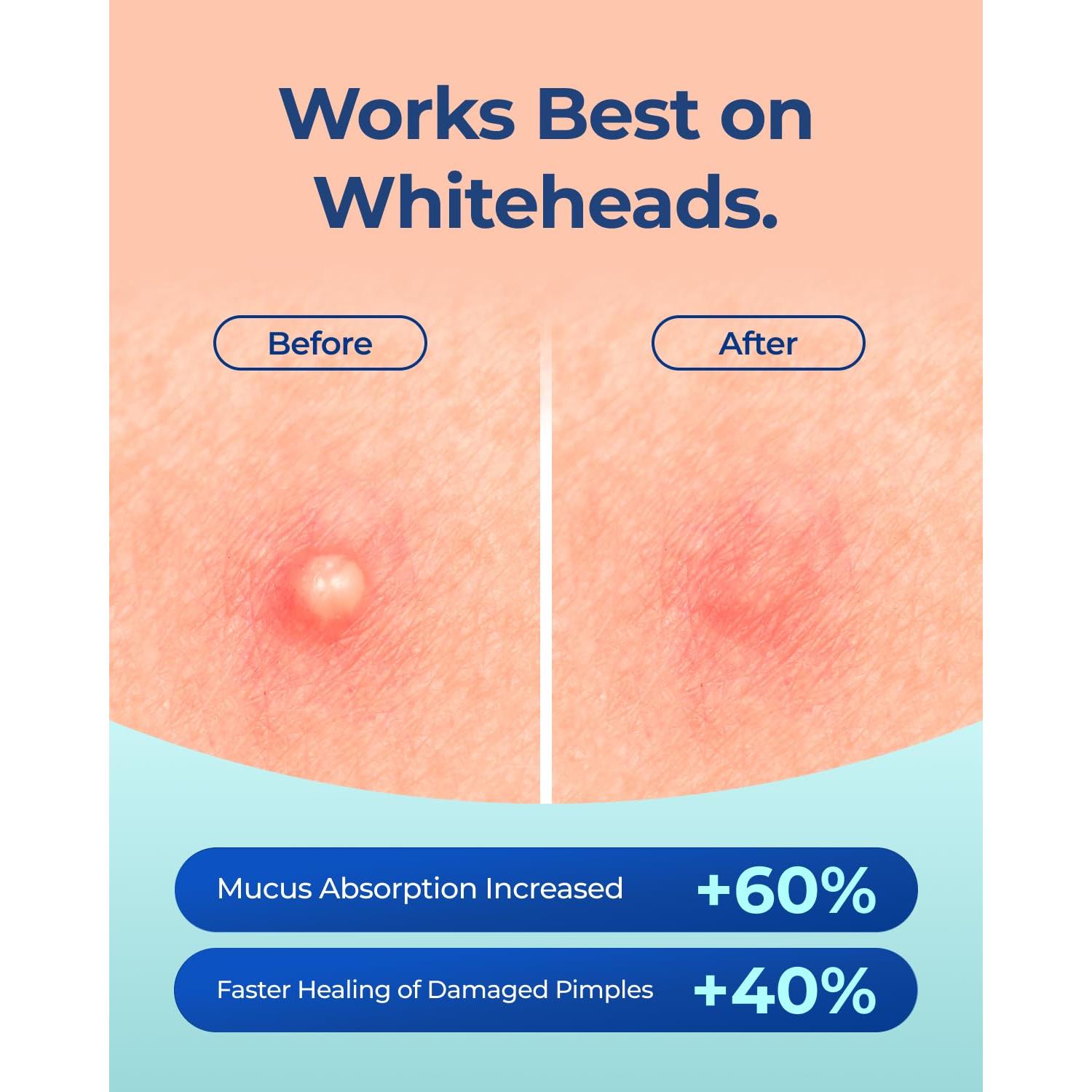 Parches Hidrocoloides Invisibles POINTMASS 308 Puntos 0.1mm