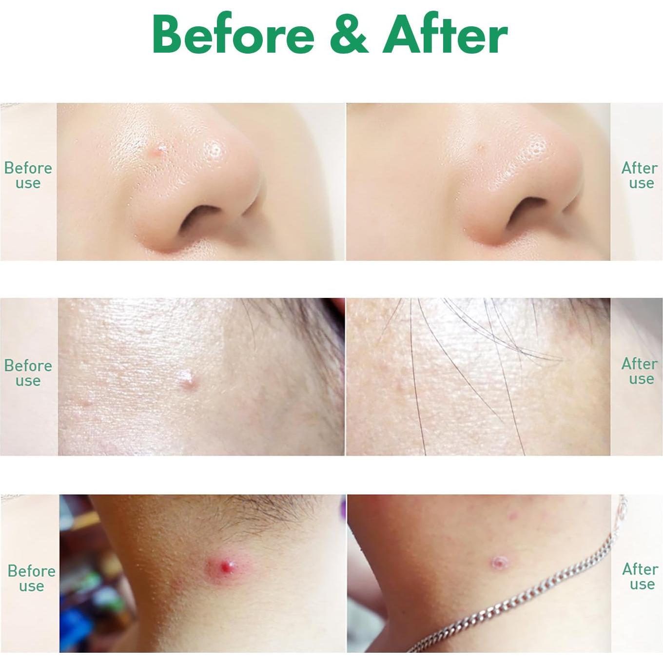 Parche Acné Acropass Trouble Care Microcone 6ct + 6 Limpiadores