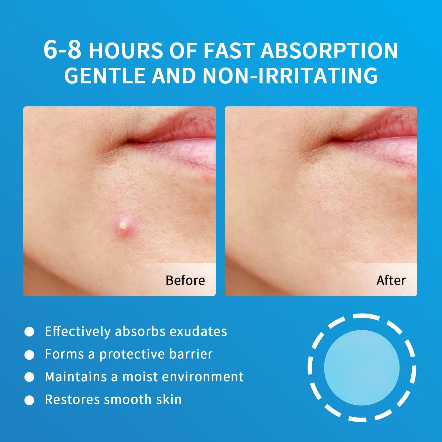 Parches para Granos Hidrocoloides GOESTRIC 216 Unidades