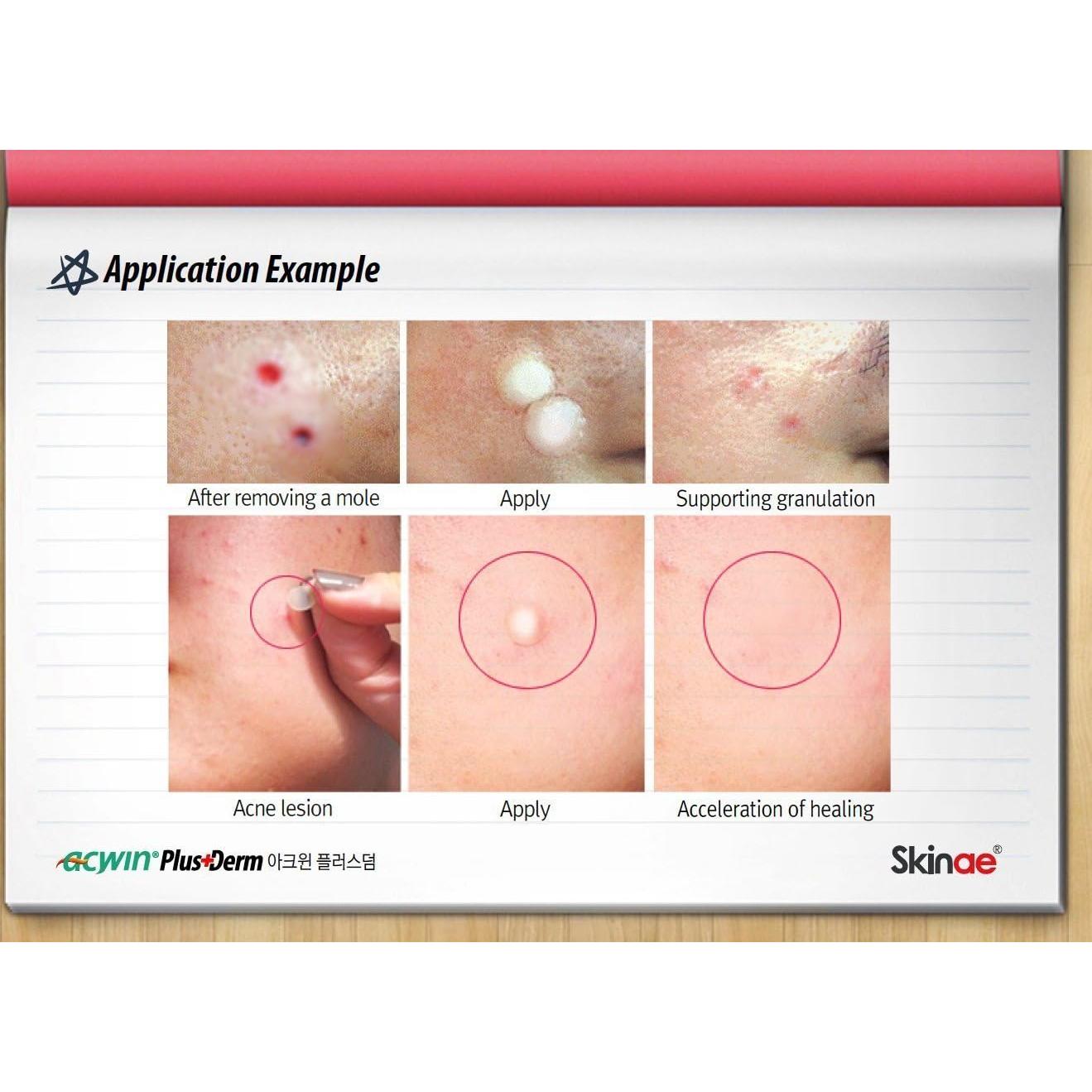 Parche Absorbente Acwin Plus Derm 204 Unidades Cuidado Espinillas