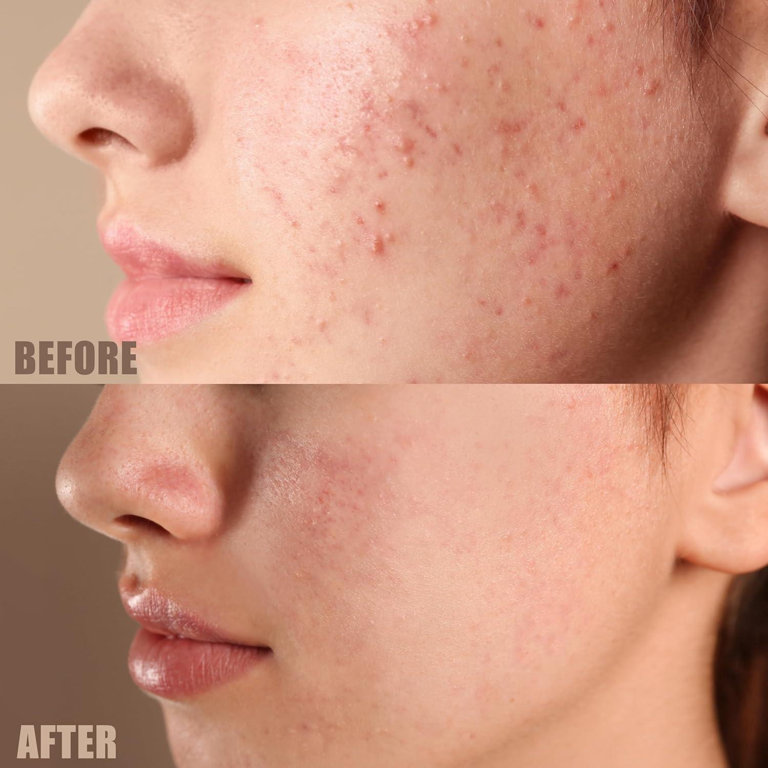 Gel Limpiador Facial TriDerma 2% Ácido Salicílico 236ml