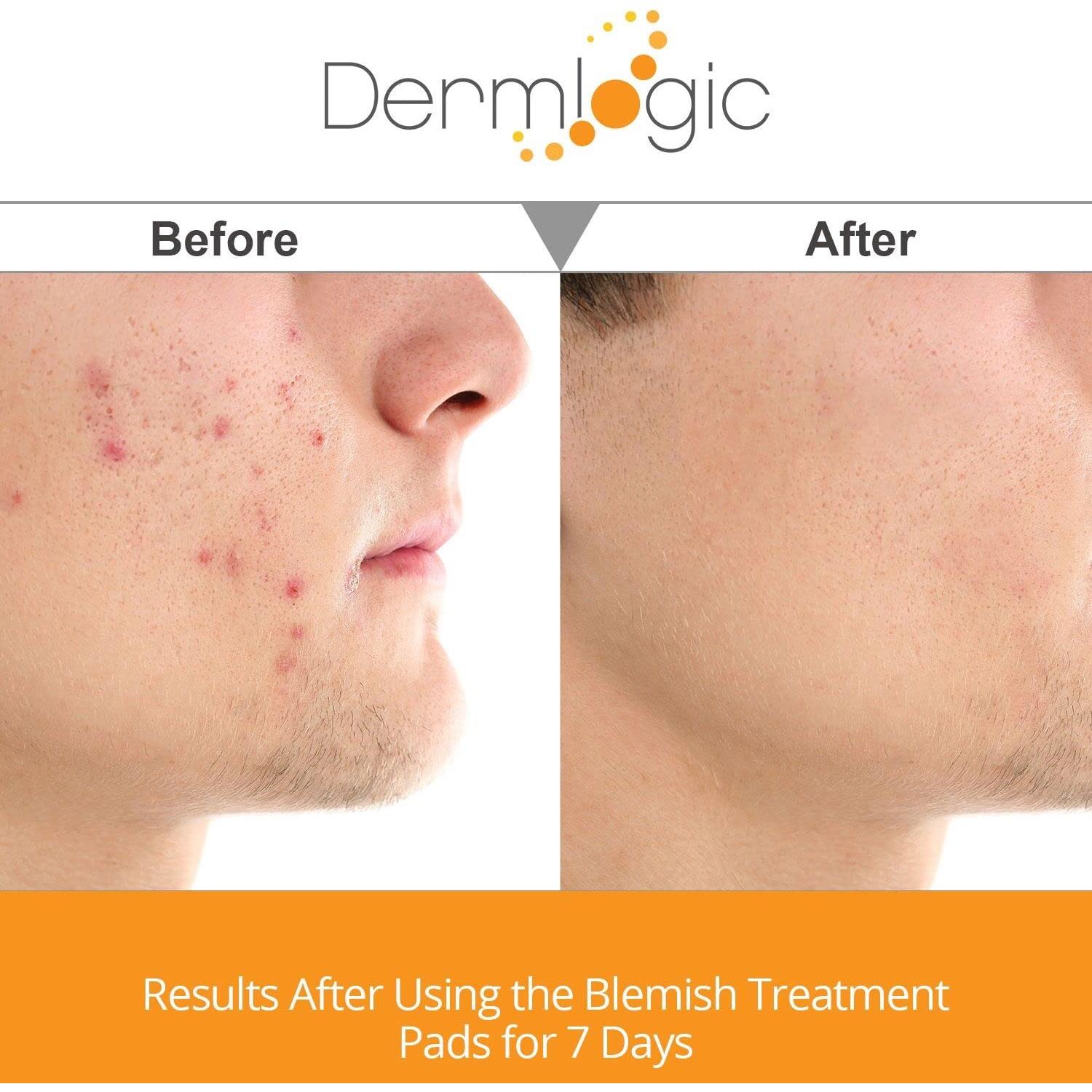 PADS Anti-Acné Dermlogic - Ácido Salicílico y Glicólico