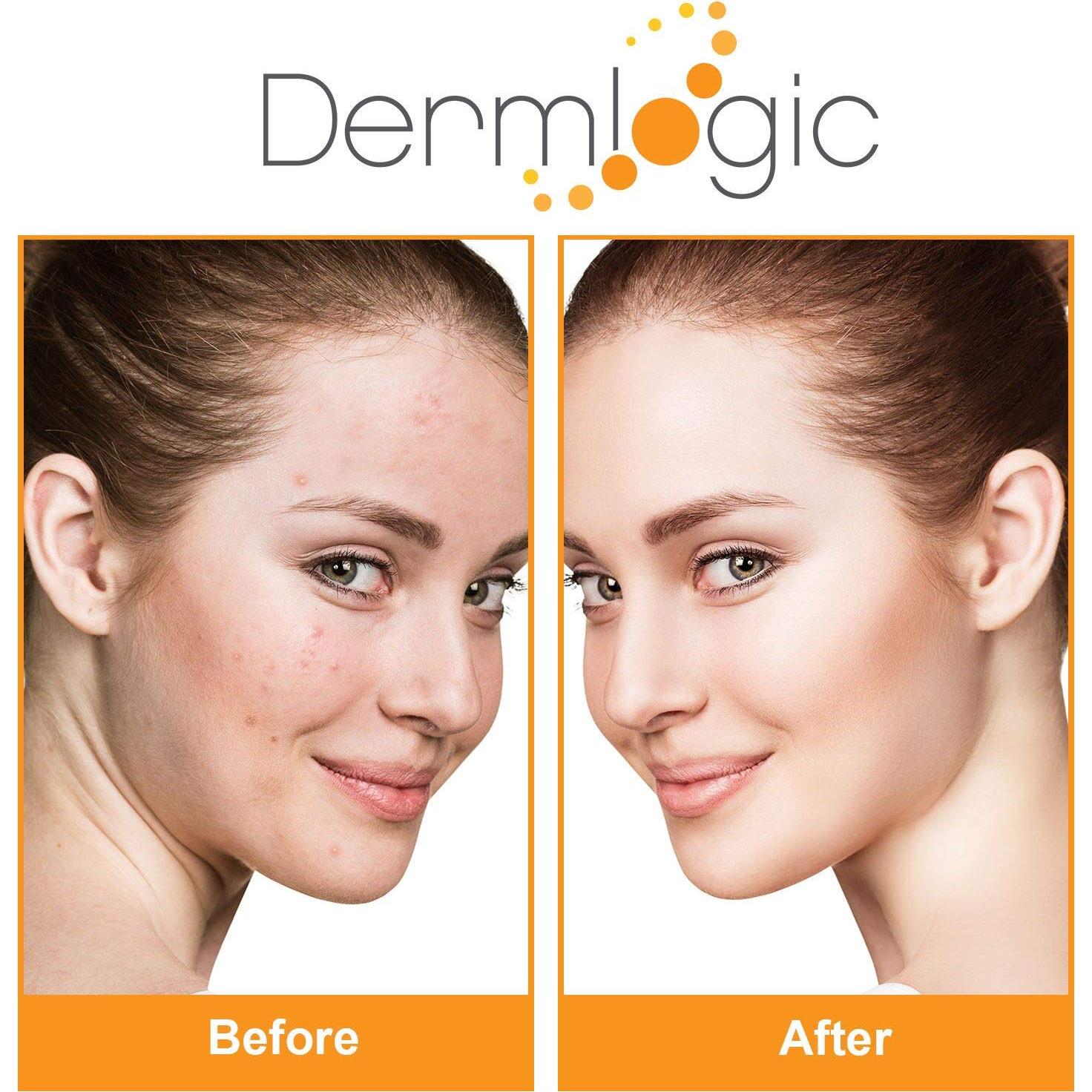 PADS Anti-Acné Dermlogic - Ácido Salicílico y Glicólico