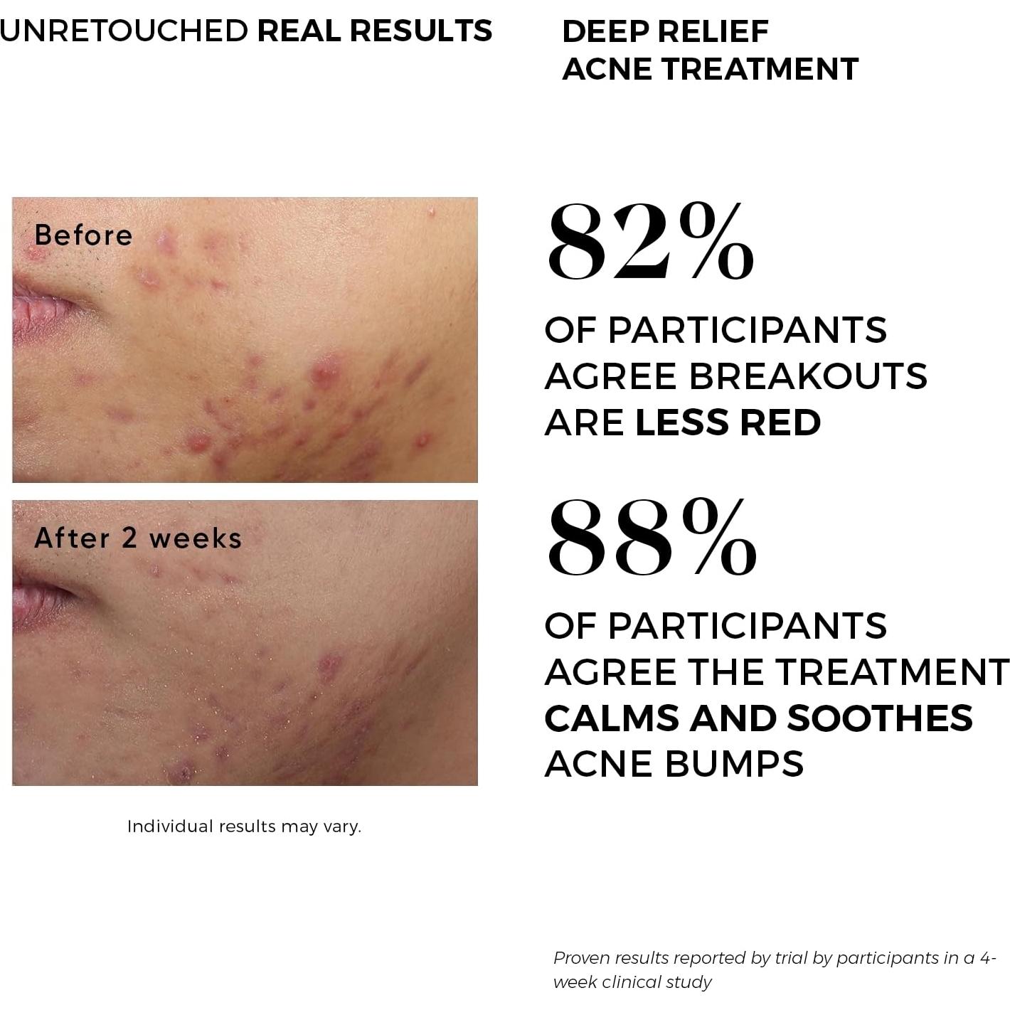 Pads Exfoliantes para Acné Dermlogic - 2% Ácido Salicílico