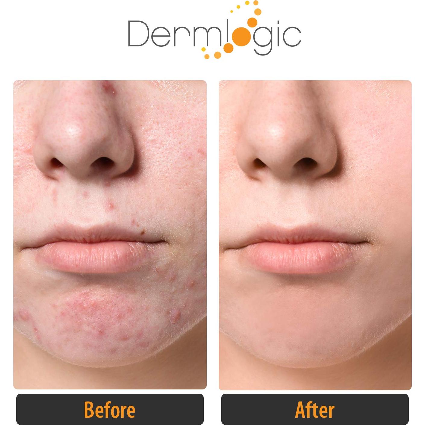 Pads Exfoliantes para Acné Dermlogic - 2% Ácido Salicílico