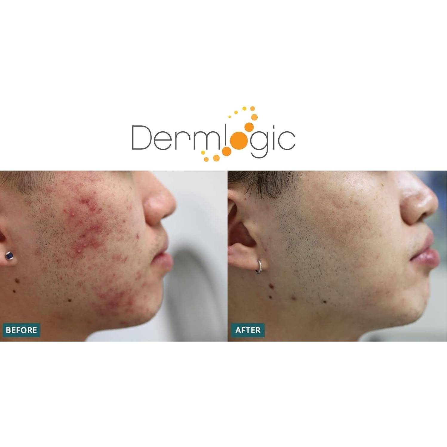 Pads Exfoliantes para Acné Dermlogic - 2% Ácido Salicílico