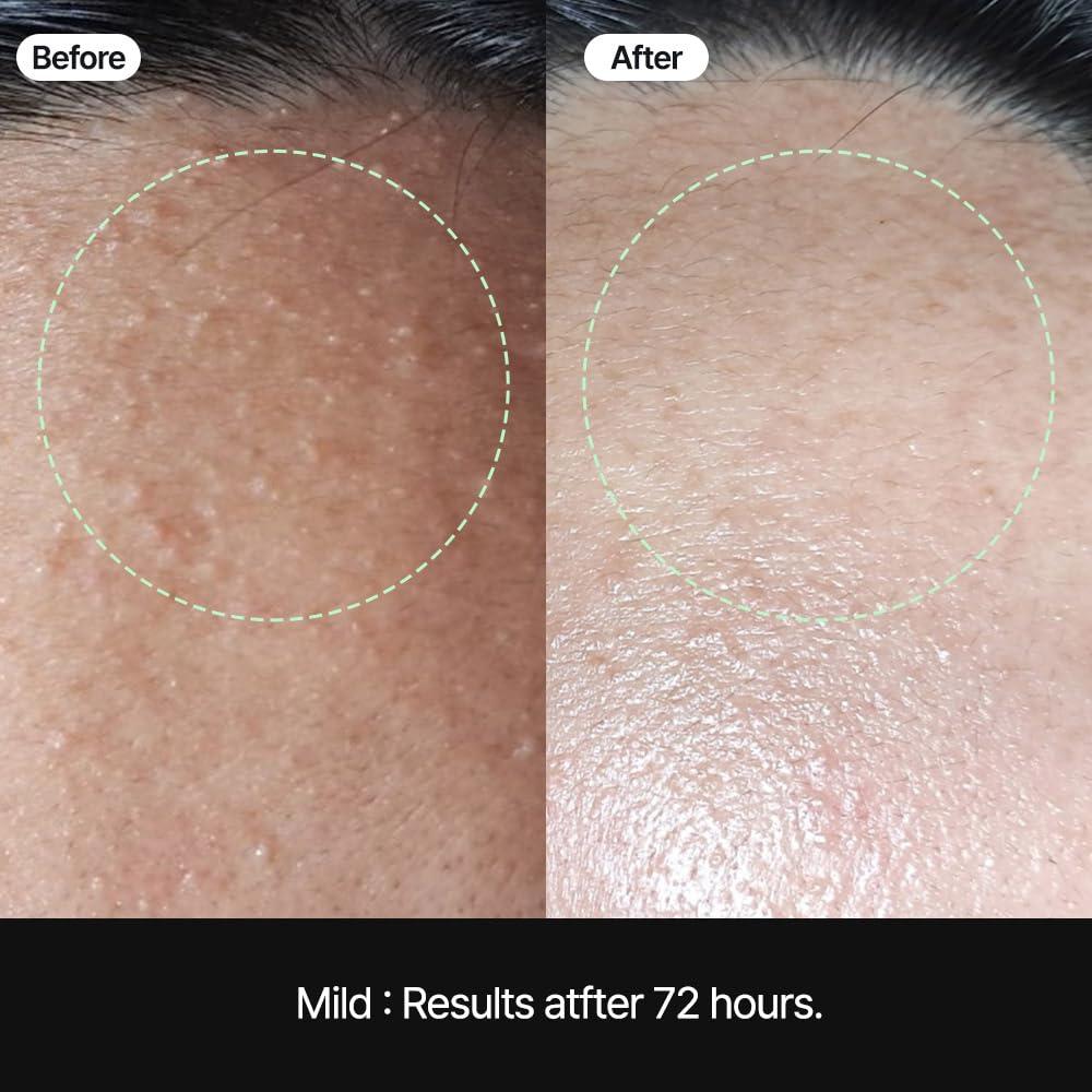 Parche Booster para Comedones Soonsak - 50 Hojas - Eliminación de Sebo