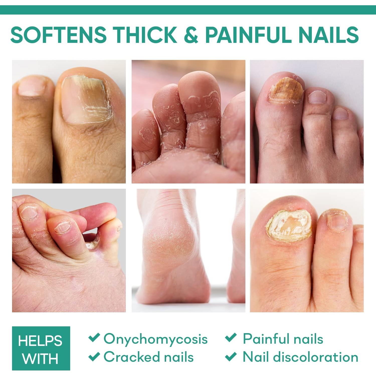 Gel de Urea 42% Ellocy - Hidratante y Removedor de Callos 119g