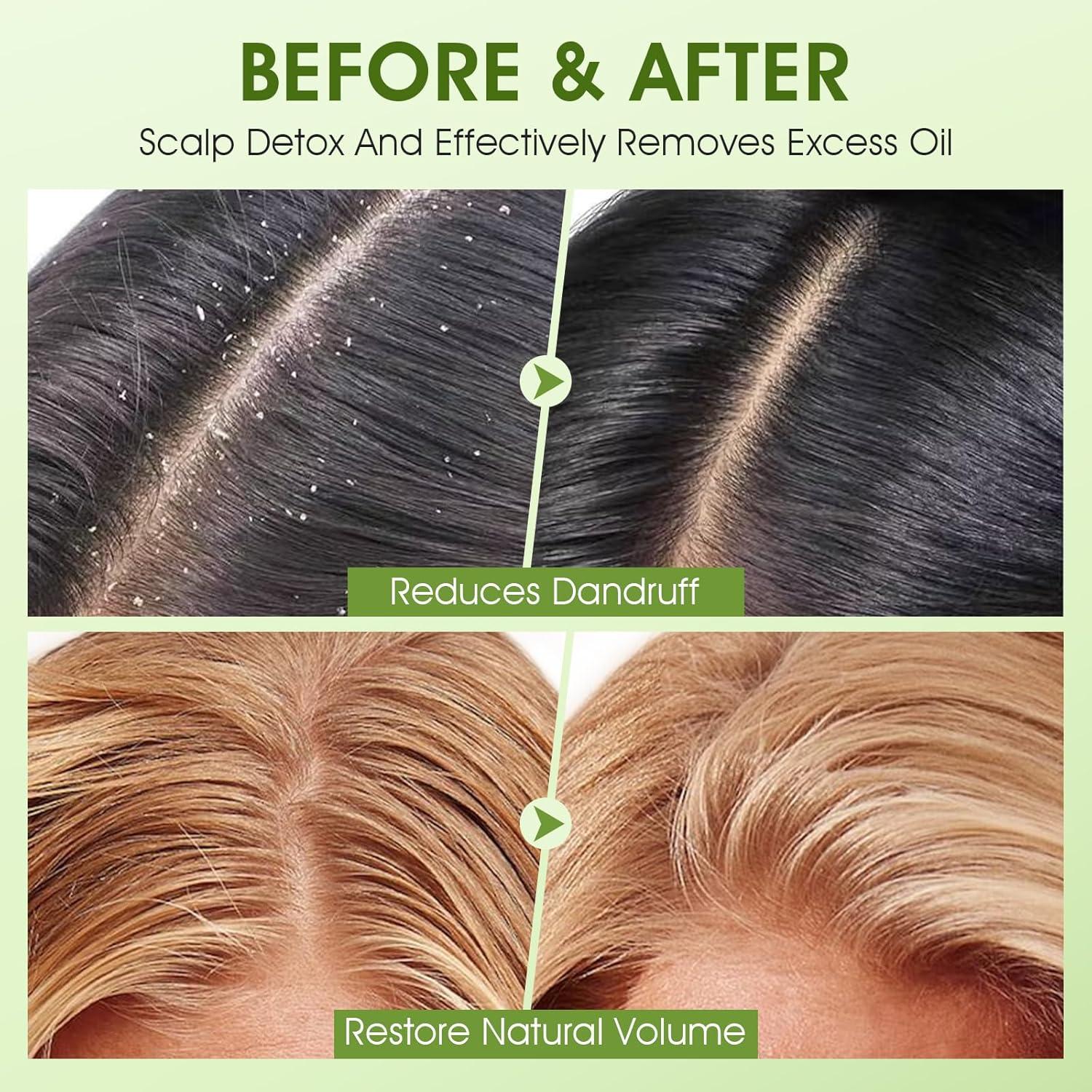 Exfoliante de Cuero Cabelludo VOERUY 300g AHA BHA con Masajeador