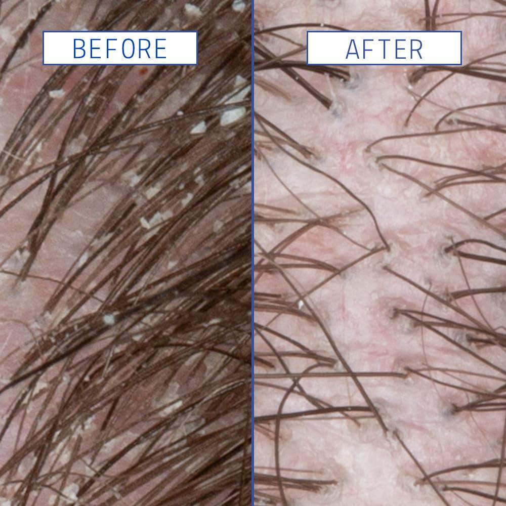 Suero AAVRANI para Cuero Cabelludo - 59.15 ml - Ácido Salicílico