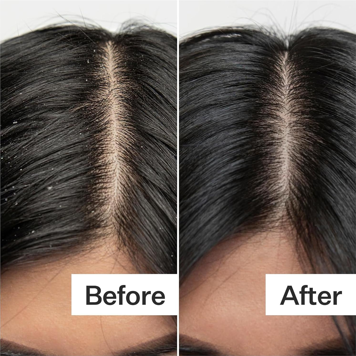 Exfoliante Cuero Cabelludo ACT+Acre 59ml | Ácido Salicílico, Papaya, Menta