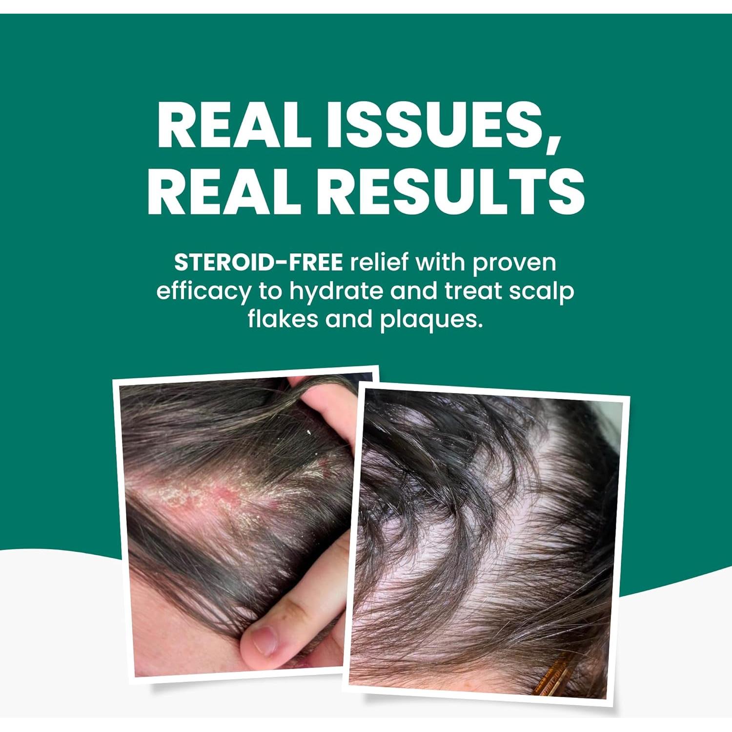 Crema para Cuero Cabelludo Grahams 60g - Alivio Picazón y Caspa