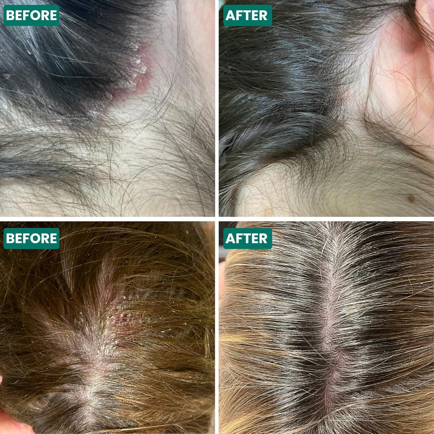 Crema para Cuero Cabelludo Grahams 60g - Alivio Picazón y Caspa