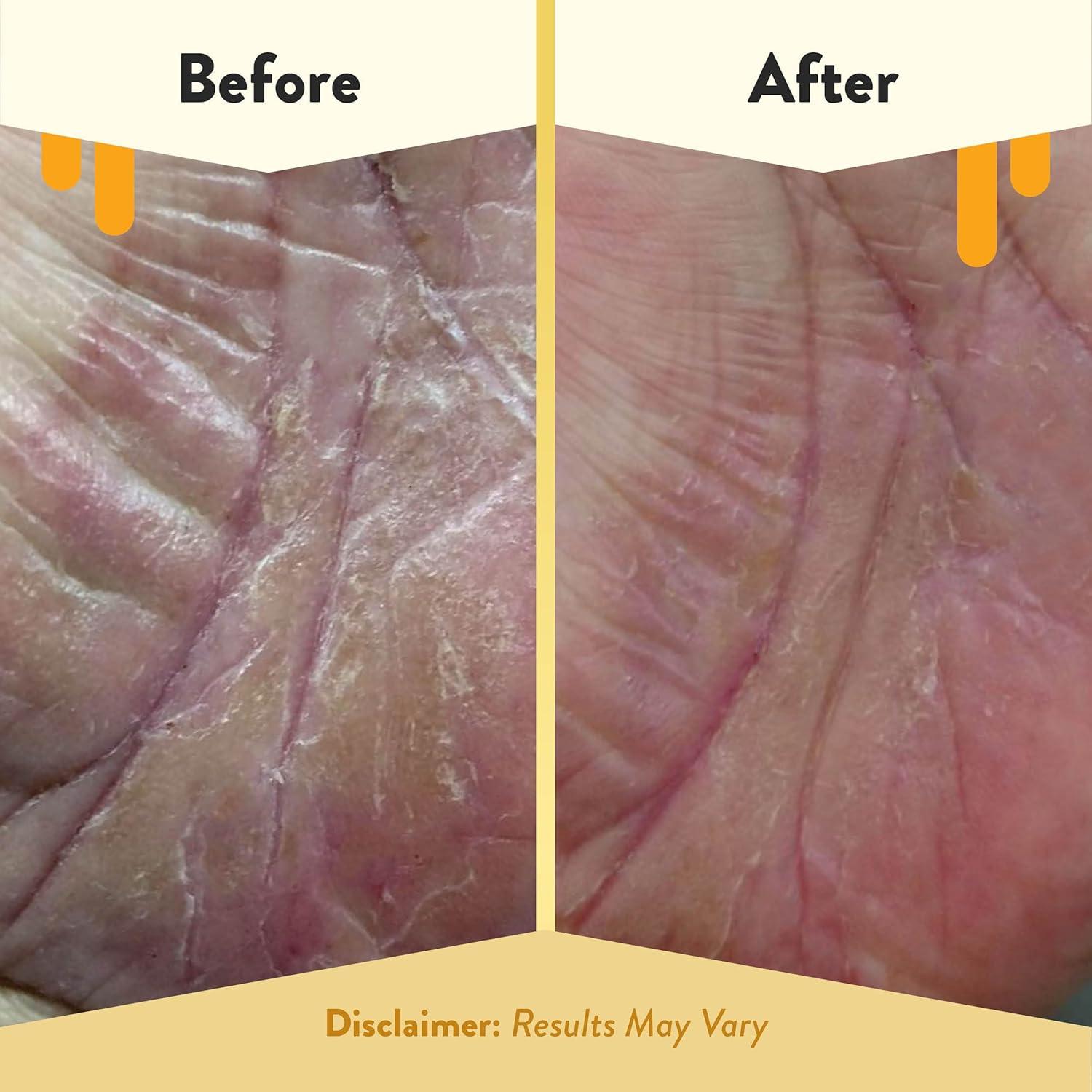 Exfoliante de Azúcar Moreno Eczema Honey 170g - Piel Seca y Sensible