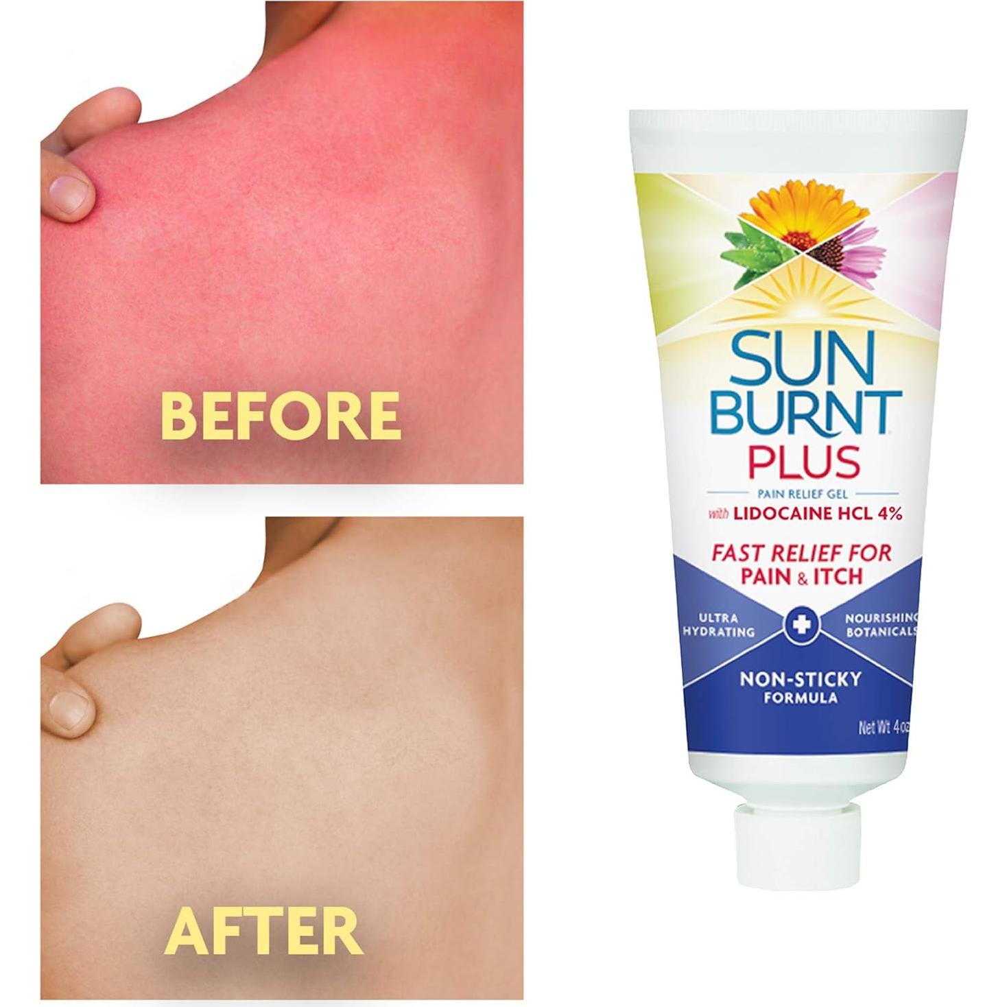 Gel After-Sun Sunburnt Plus con Lidocaína 113g - Alivio Rápido