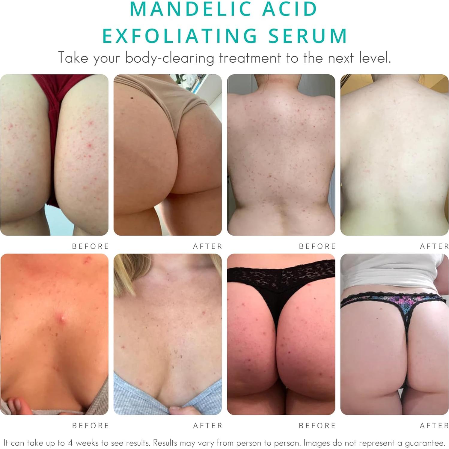 Suero Corporal para Acné Almond Clear 30 ml - Ácido Mandélico