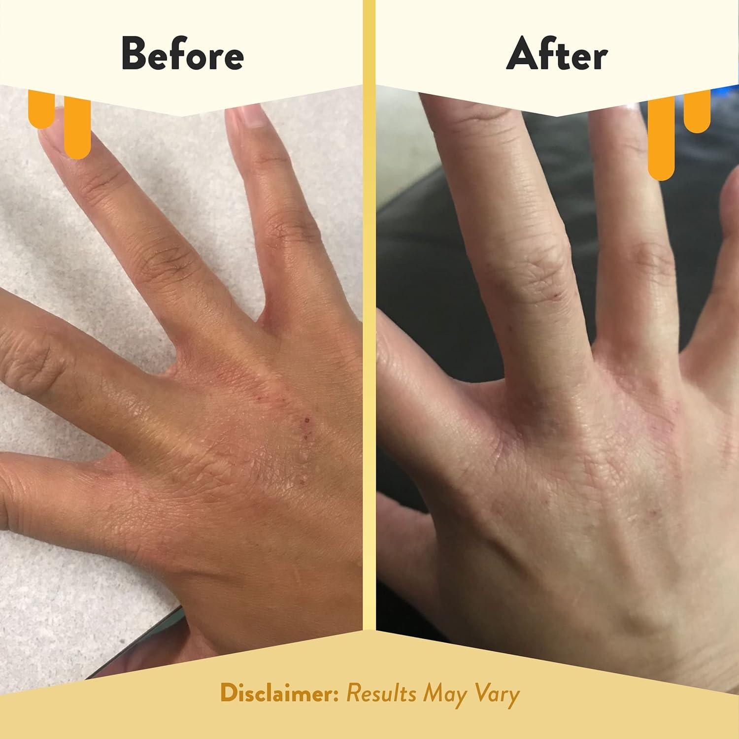 Spray Hidratante Facial Eczema Honey 255g - Hamamelis y Aloe