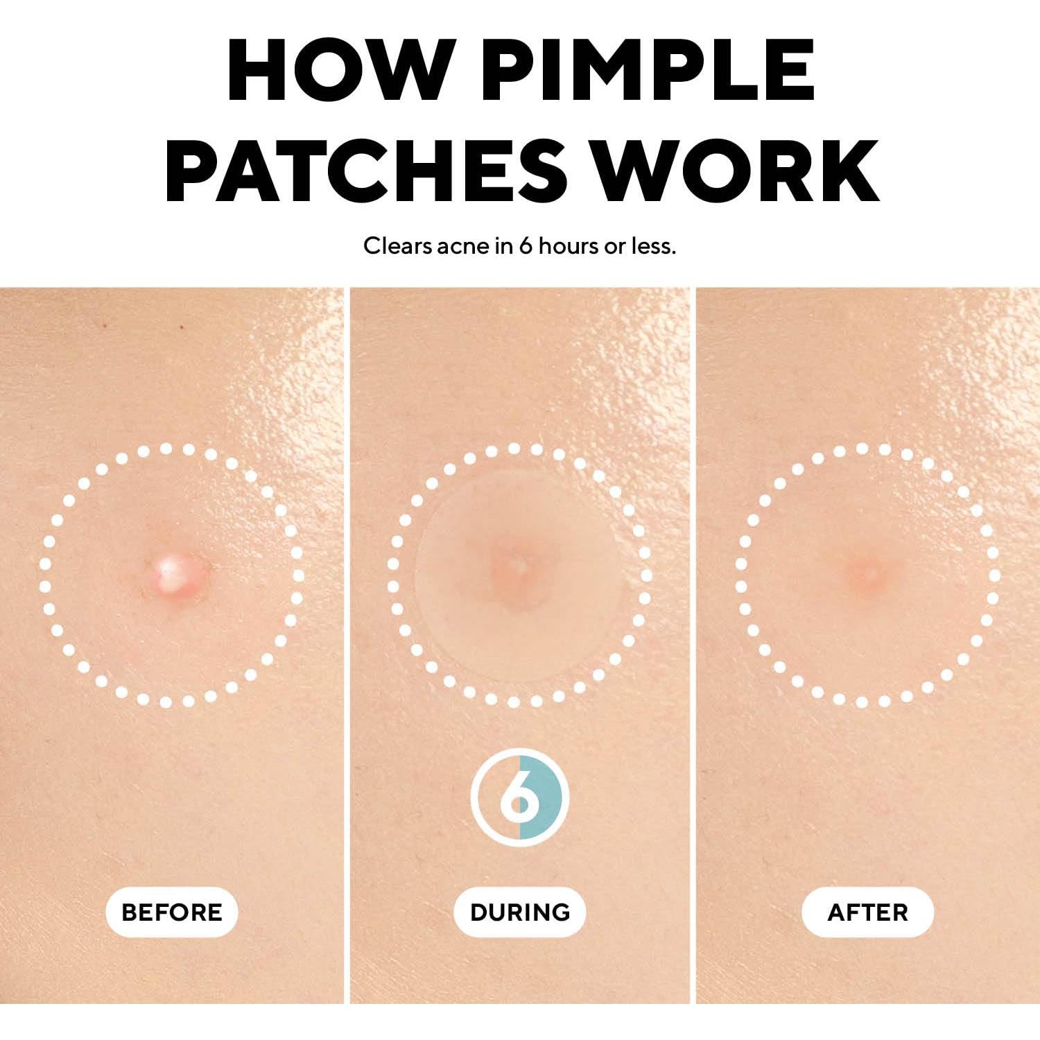 Parches Hidrocoloides para Granitos Caraseoul - 44 Unidades