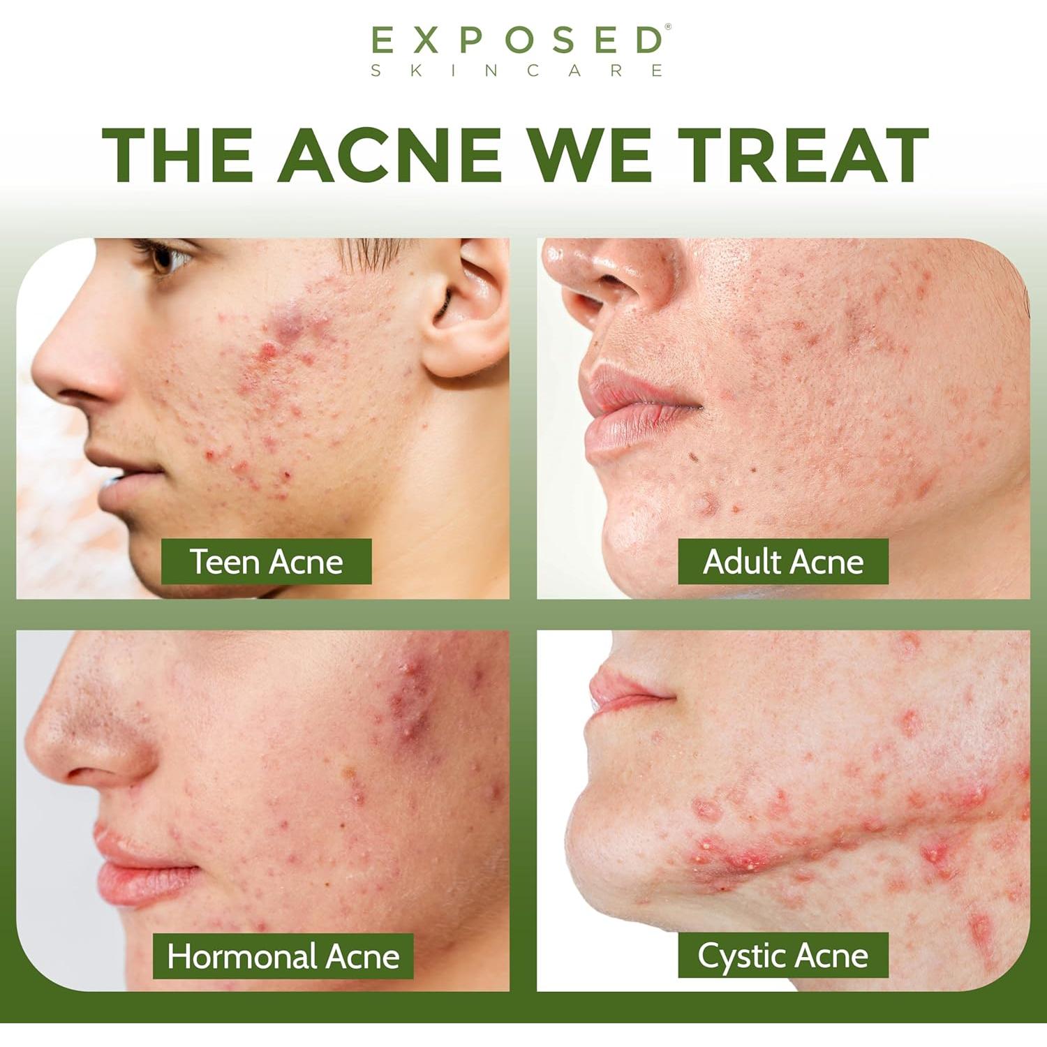 Suero Clear Pore Exposed Skin Care - Té Verde y Ácido Salicílico