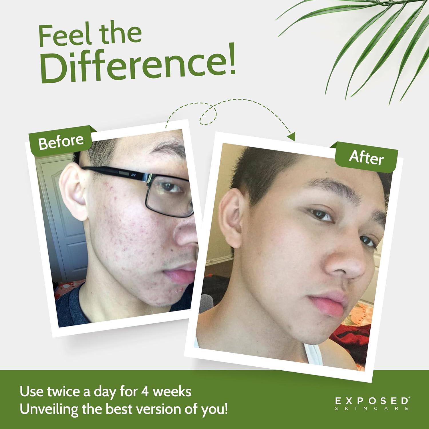 Suero Clear Pore Exposed Skin Care - Té Verde y Ácido Salicílico