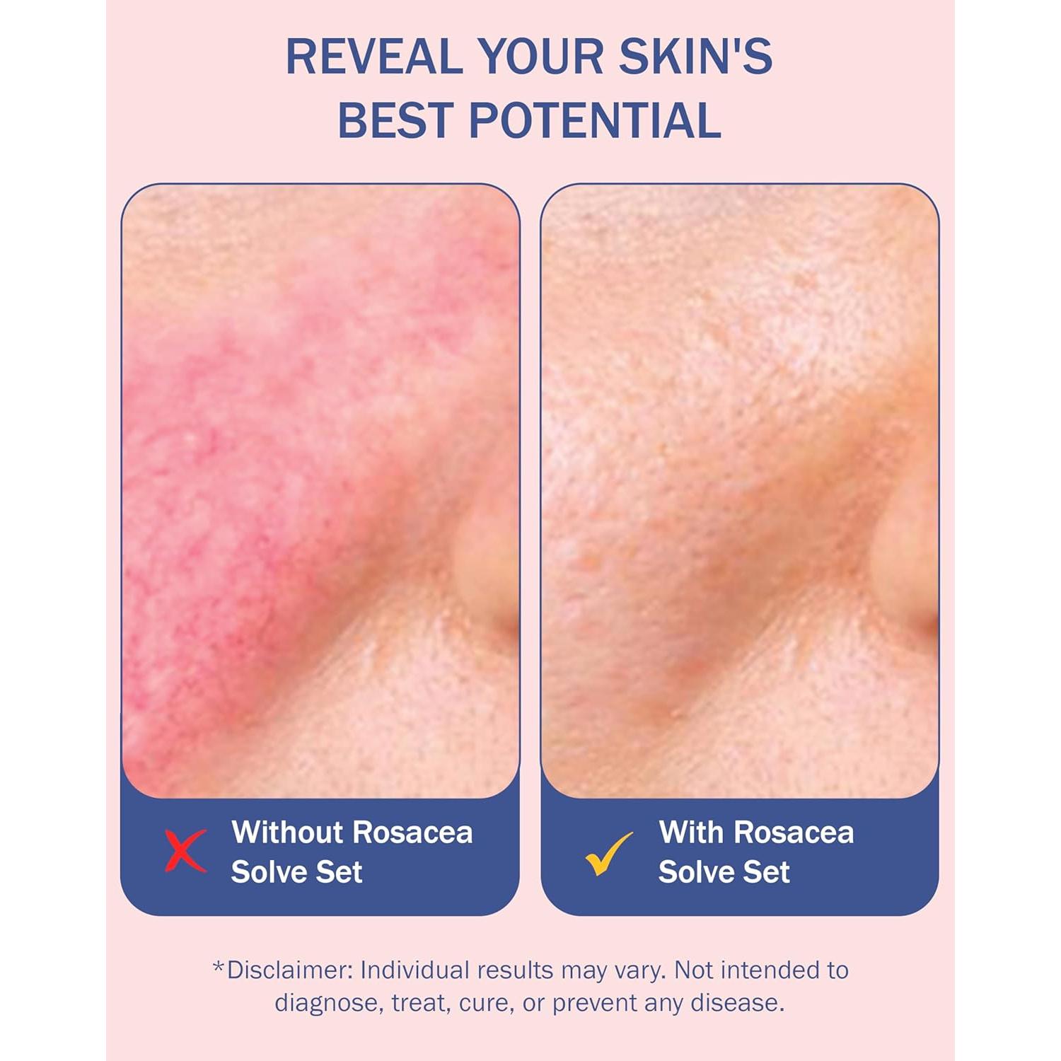 Conjunto Cuidado Piel Rosácea e70 - Limpiador, Crema y Suero