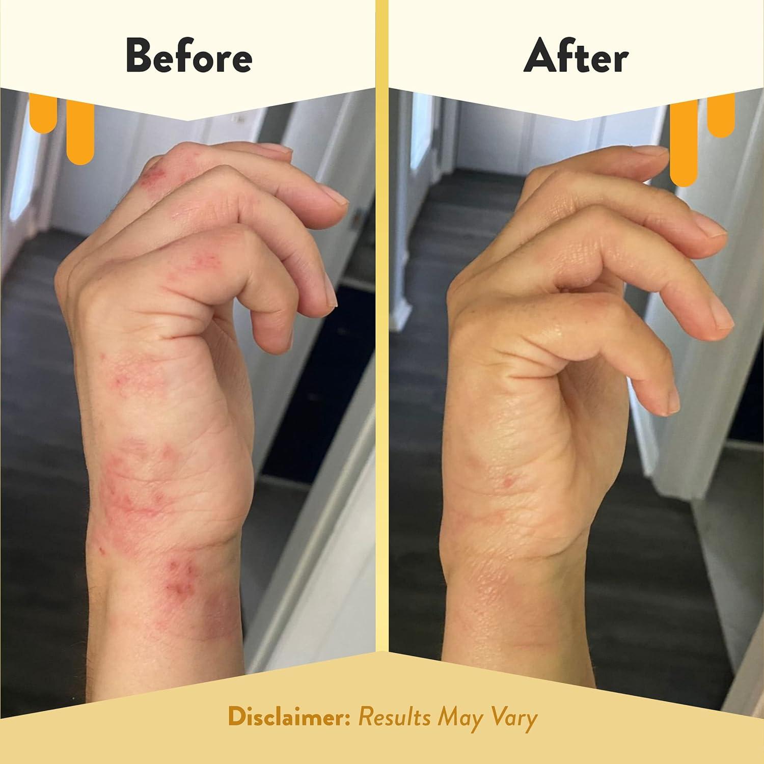 Aceite Corporal Antioxidante ECZEMA HONEY 236.6 ml - Hidratante Sin Fragancia para Piel Seca