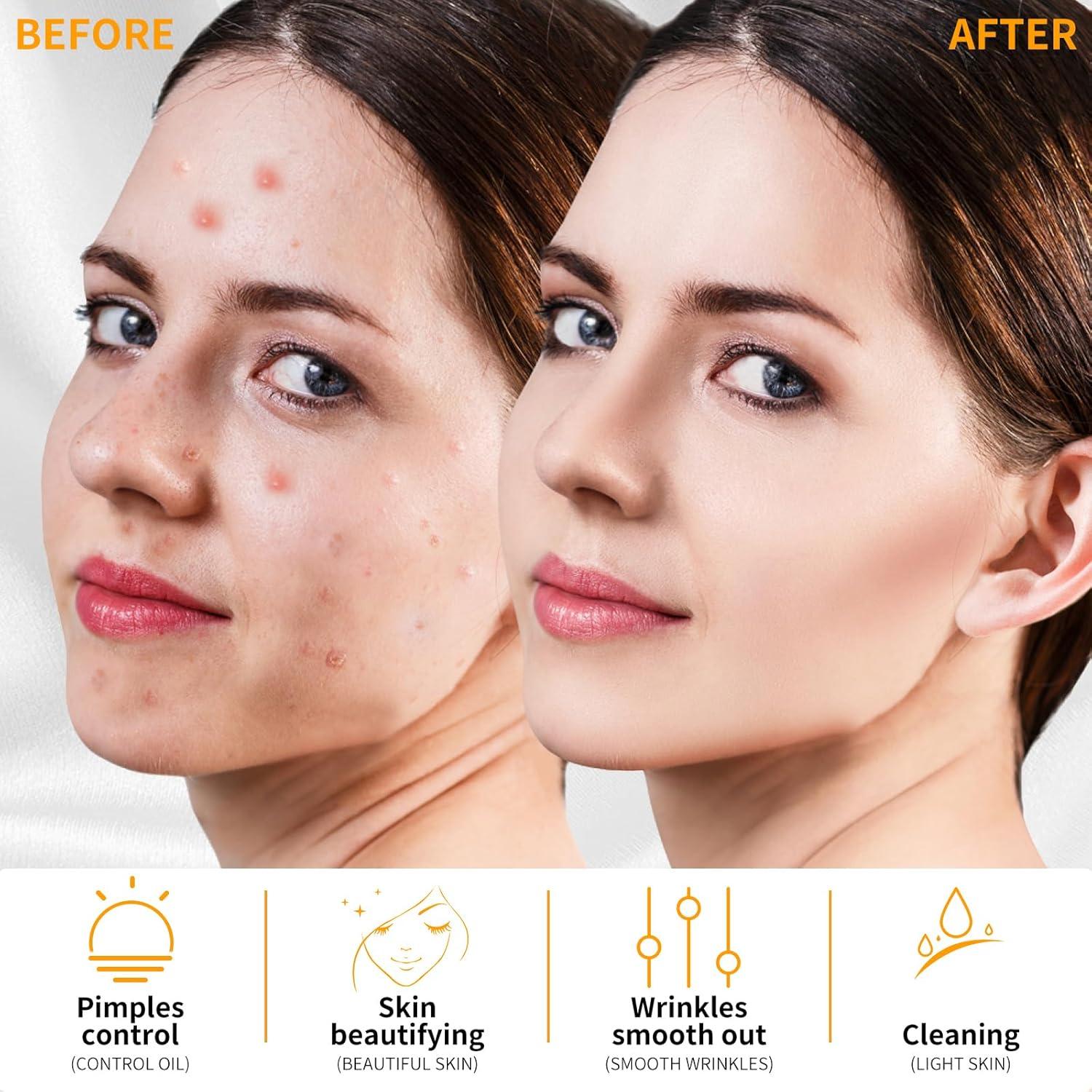 Máquina de Cuidado Facial Portátil MYSWEETY Alta Frecuencia