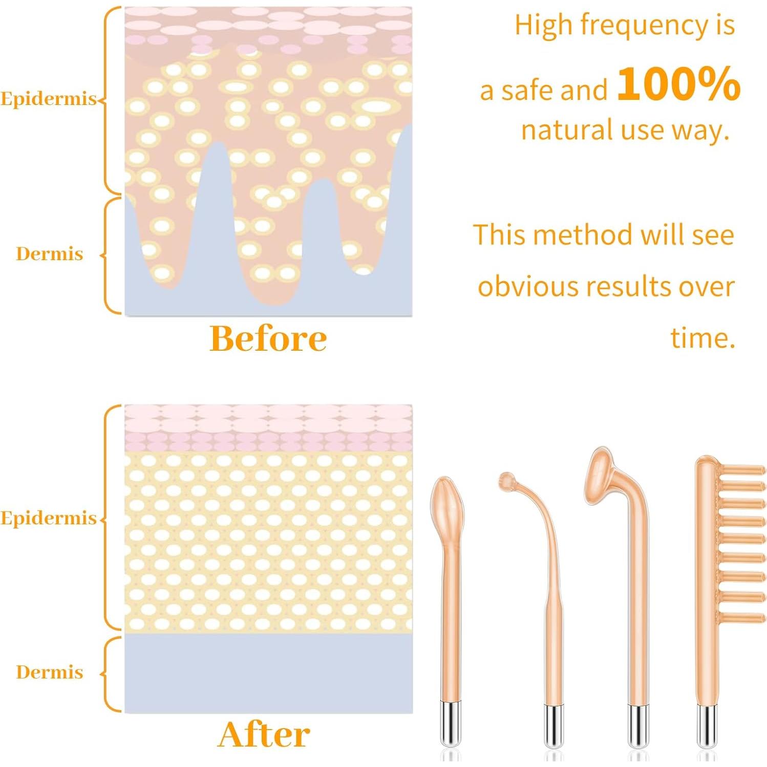 Máquina de Cuidado Facial Portátil MYSWEETY Alta Frecuencia