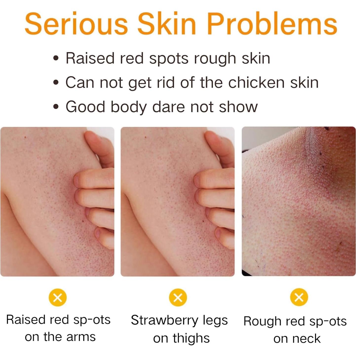 Strawberry Legs Treatment For Women - Kera-tosis Pil-aris Treatment Lotion for Dry Skin - Strawberry Skin Trea-tment Body Moisturizer - Rough and Bumpy Skin Lotion - Straw berry S kin Remover
