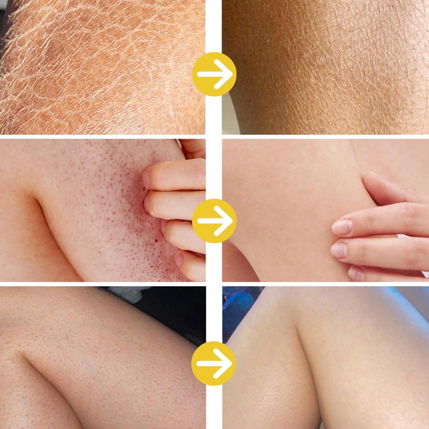 Strawberry Legs Treatment For Women - Kera-tosis Pil-aris Treatment Lotion for Dry Skin - Strawberry Skin Trea-tment Body Moisturizer - Rough and Bumpy Skin Lotion - Straw berry S kin Remover