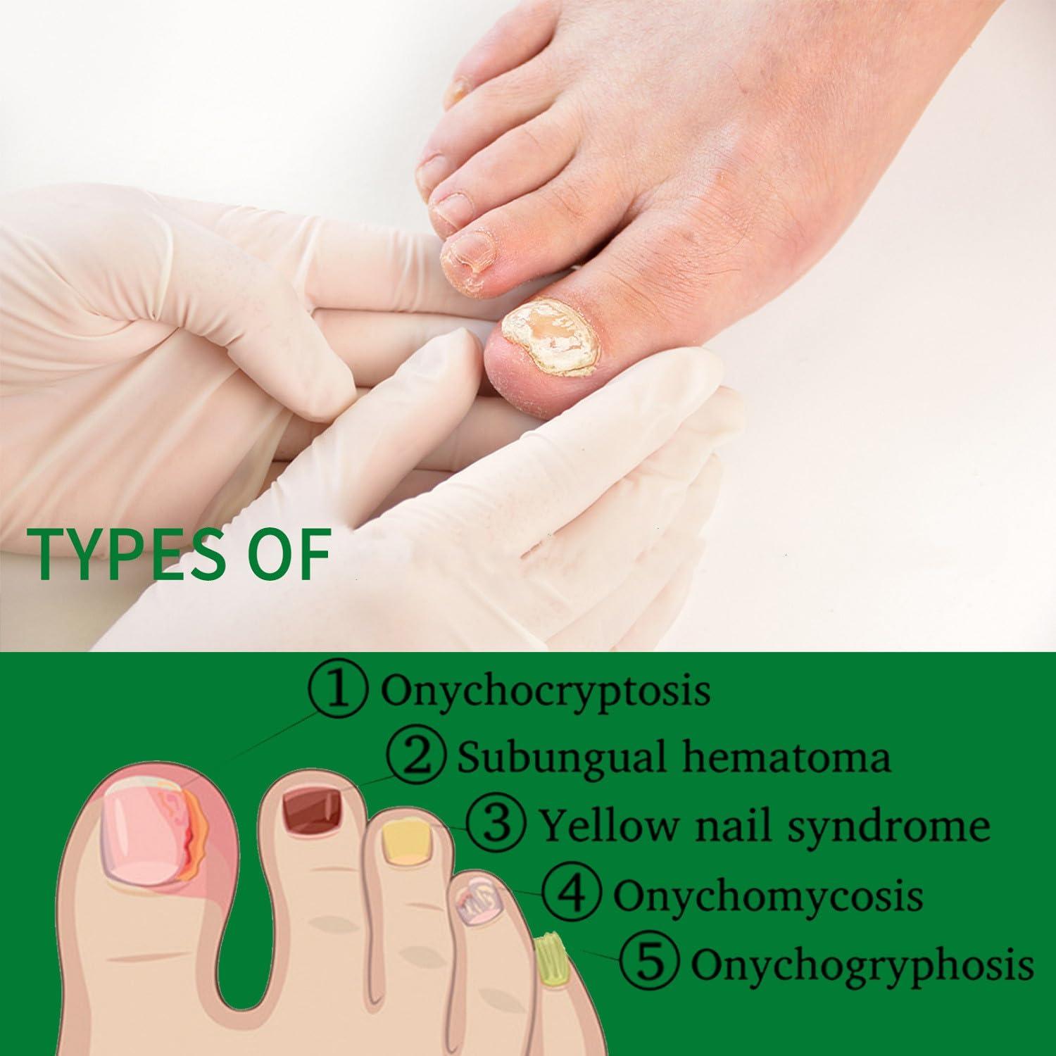 Suero de Crecimiento de Uñas de Jengibre LOYOTICE 30ml