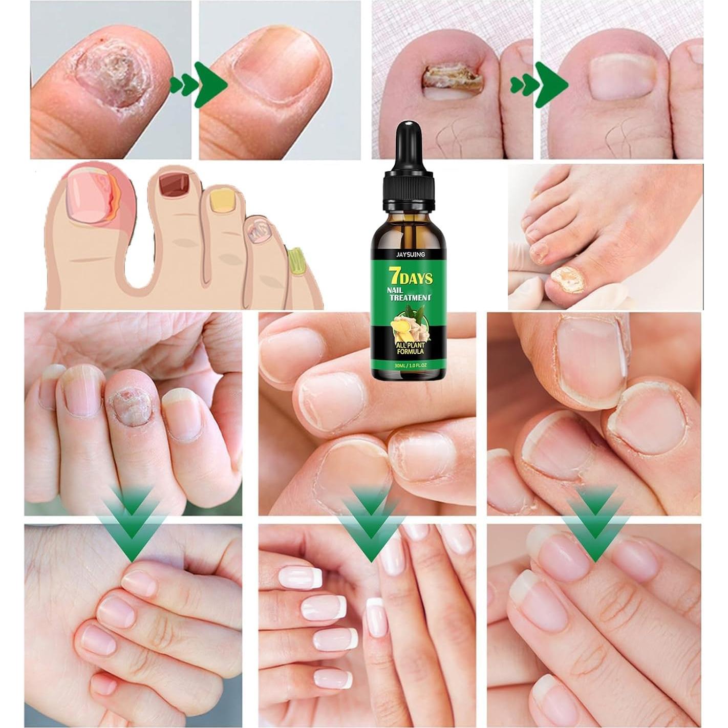 Suero de Cuidado de Uñas de Jengibre ZJRC 3PCS - Hidratante y Fortalecedor