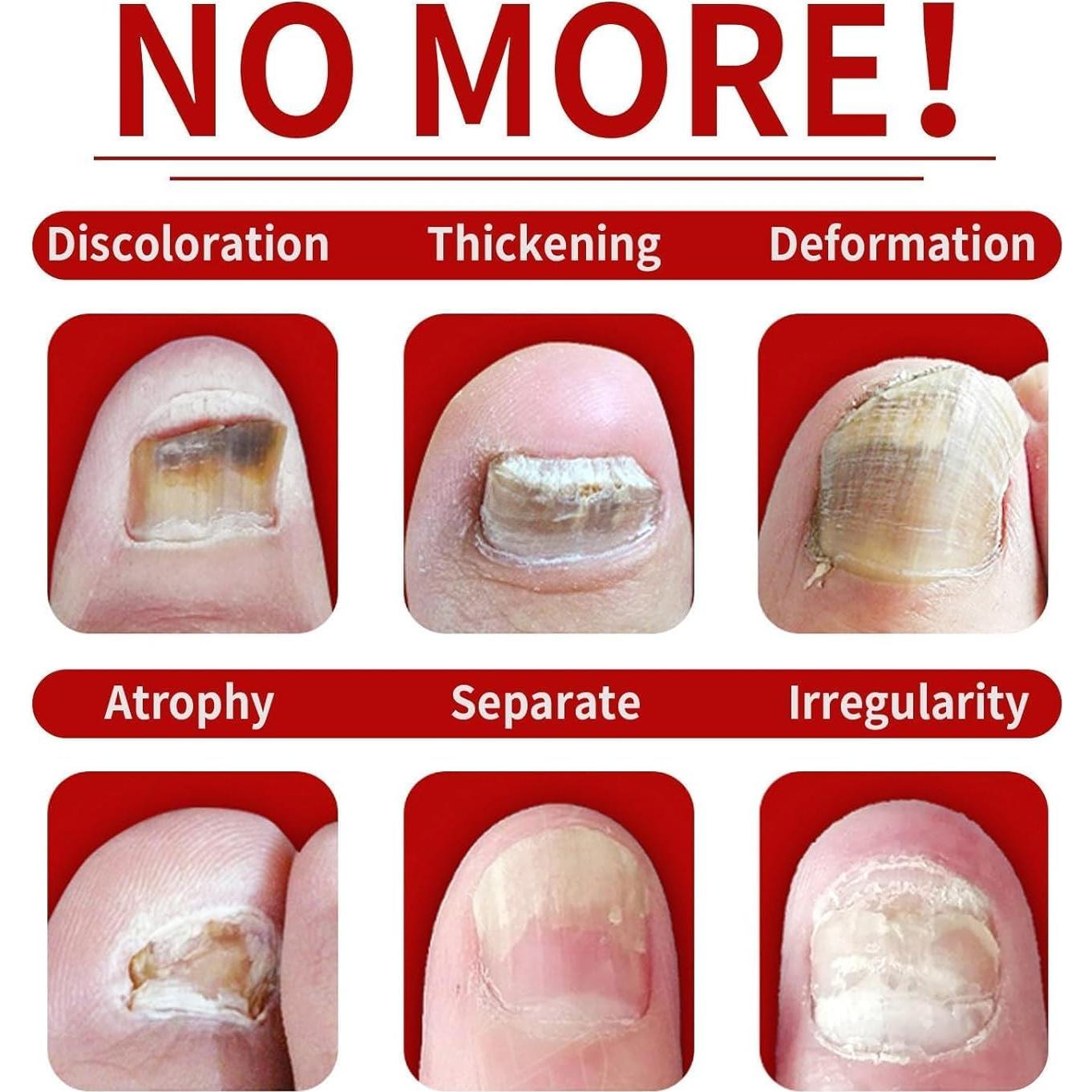 Suero de Cuidado de Uñas de Jengibre ZJRC 3PCS - Hidratante y Fortalecedor