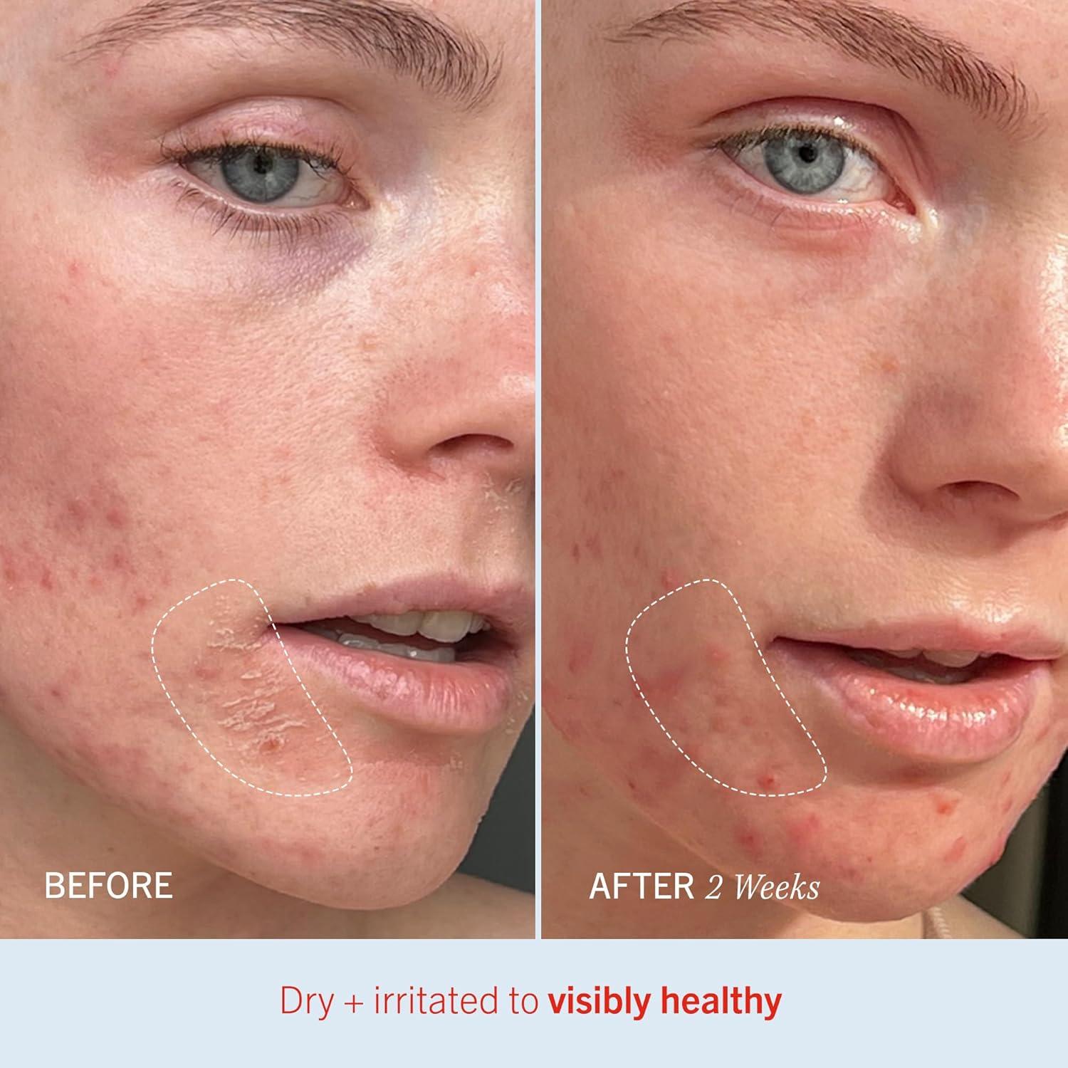 Crema Ultra Reparadora First Aid Beauty 340 g - Hidratación Eczema