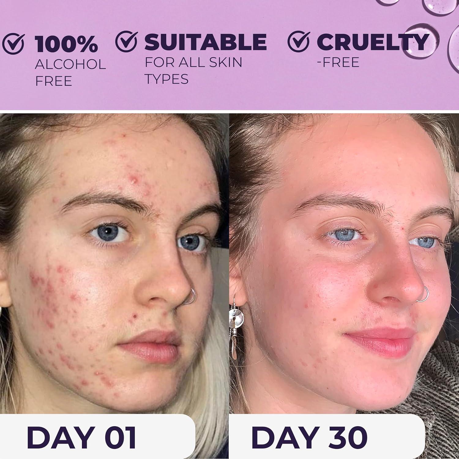 Tónico Facial NXN Antiacné con Ácido Salicílico y Probioticos