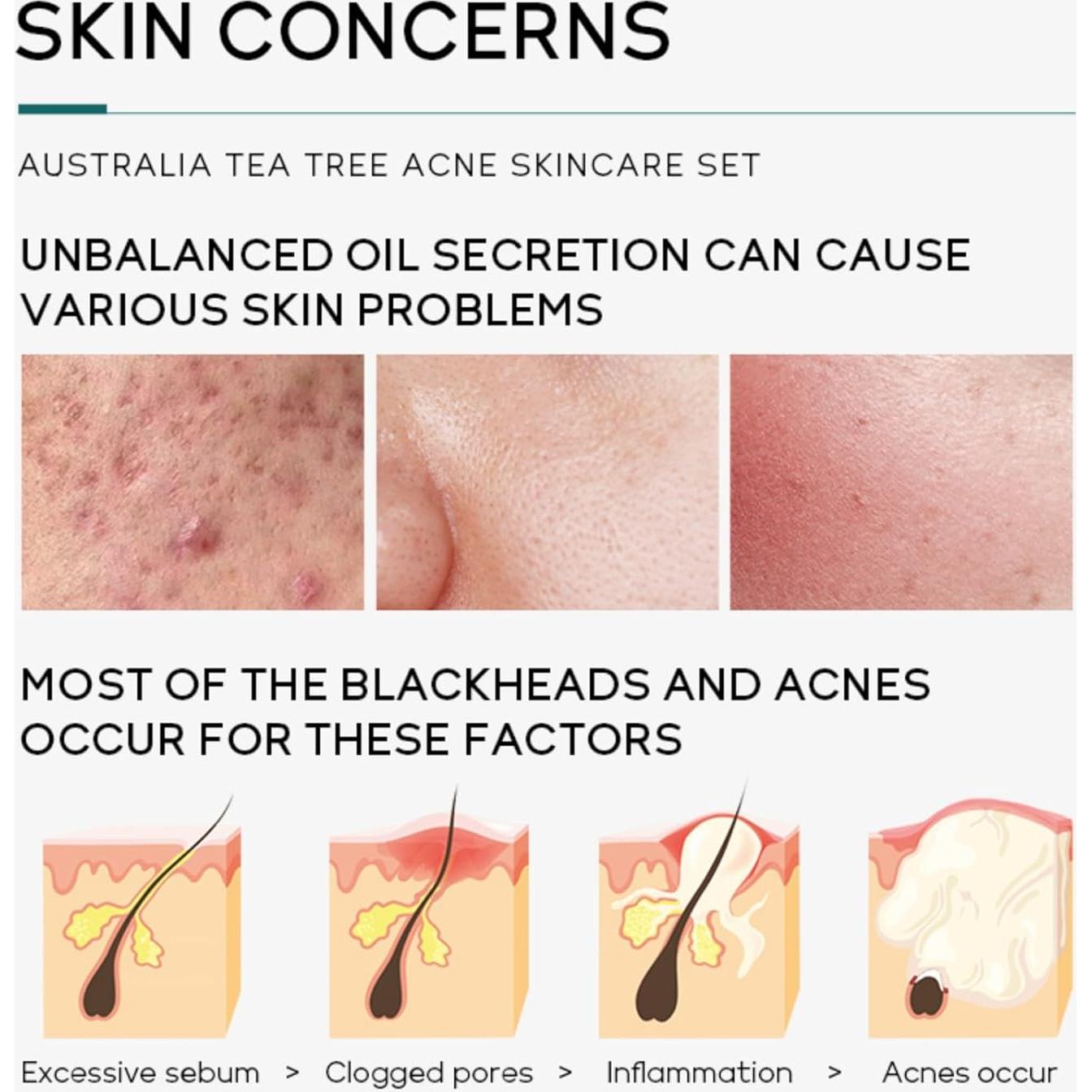 Set de Cuidado Facial Onkessy 5 Piezas Tratamiento Acné