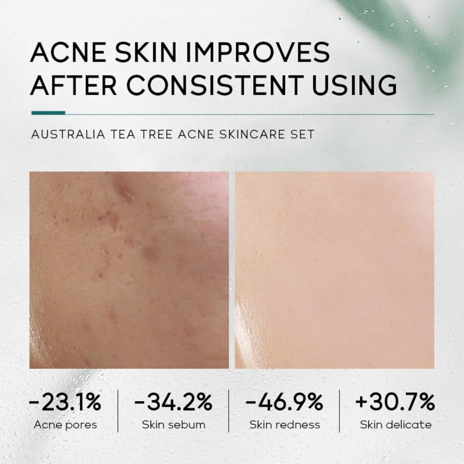 Set de Cuidado Facial Onkessy 5 Piezas Tratamiento Acné