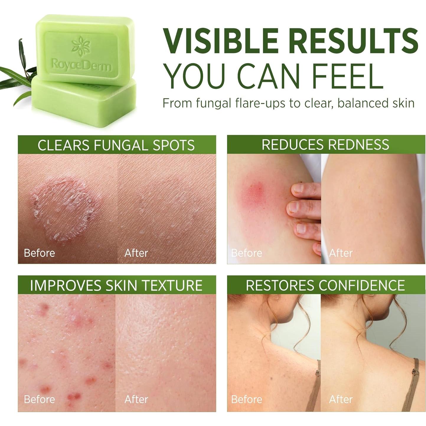 Jabón Antifúngico Antibacteriano Roycederm 226g Tea Tree